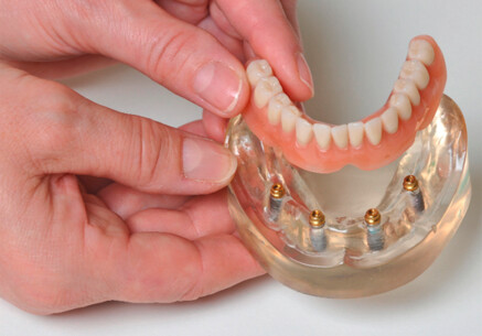 Die Spezialisten für Implantat-Zahnersatz