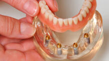 Die Spezialisten für Implantat-Zahnersatz