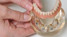 Die Spezialisten für Implantat-Zahnersatz