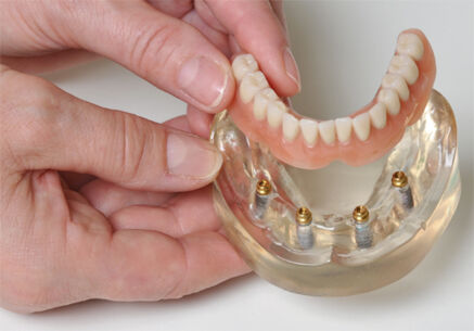 Die Spezialisten für Implantat-Zahnersatz