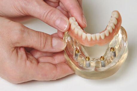 Die Spezialisten für Implantat-Zahnersatz